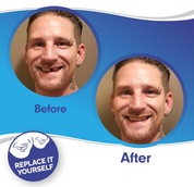Smile Plavier (Upper & inférieur inclus) 1