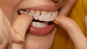 Transformation instantanée du sourire avec les facettes Snap on Smile 6