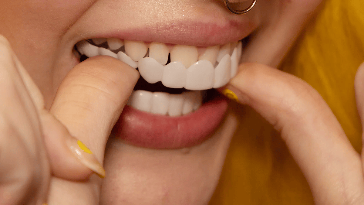 Transformation instantanée du sourire avec les facettes Snap on Smile 6